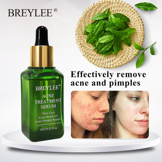 BREYLEE acne treatment serum bottle, before and after skin results, green leaves on basket
