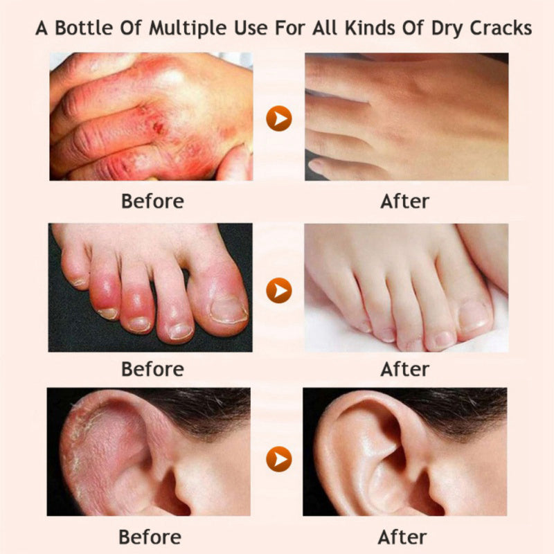 Before and after photos showing improvement of dry, cracked hands, feet, and ear skin using moisturizer