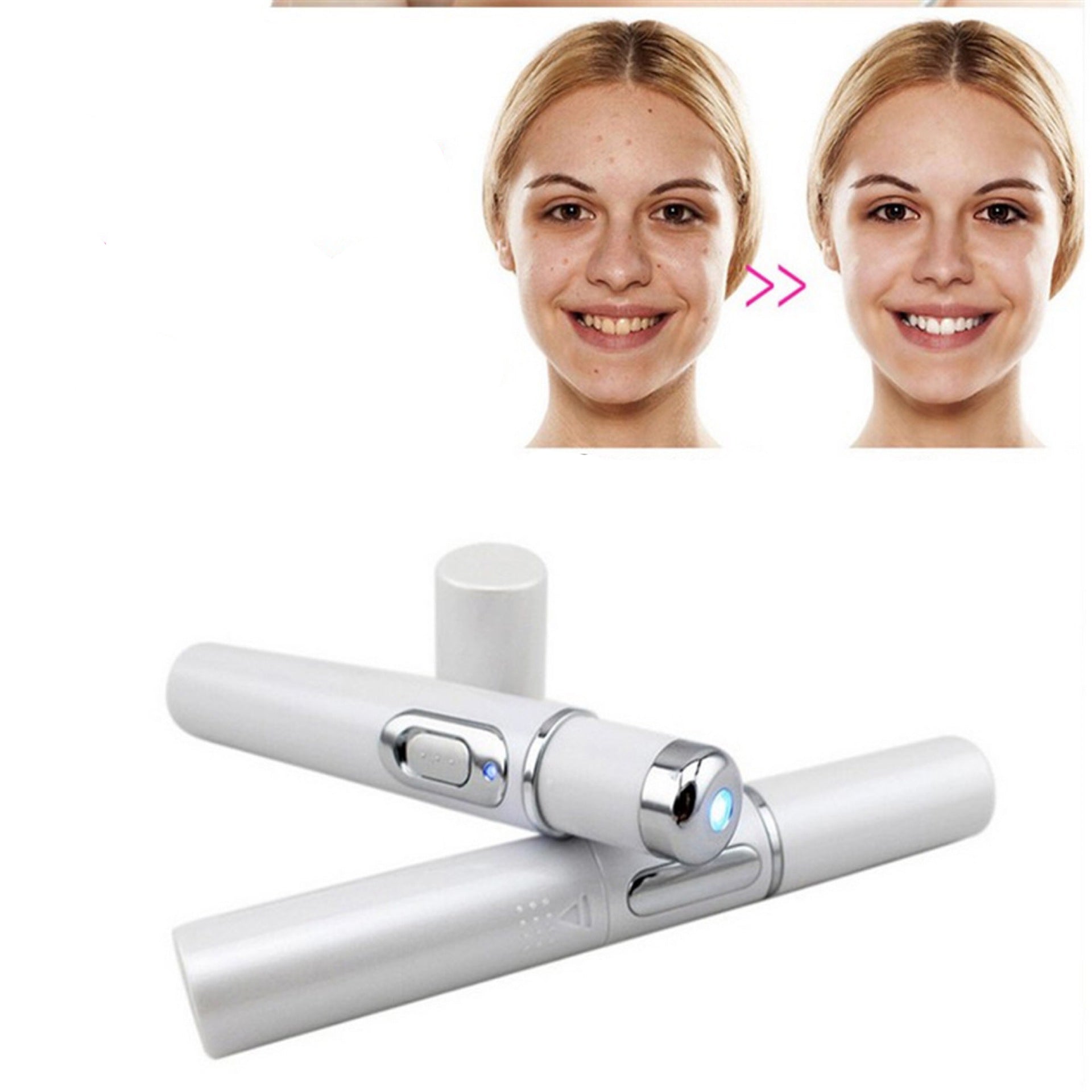 Facial treatment device with before and after acne results, FashionRay skincare tool